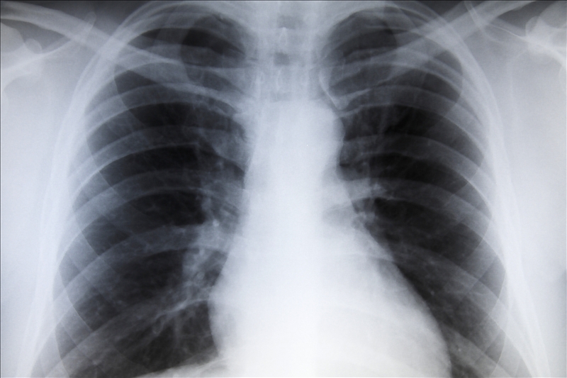 Chest_X-Ray.jpg